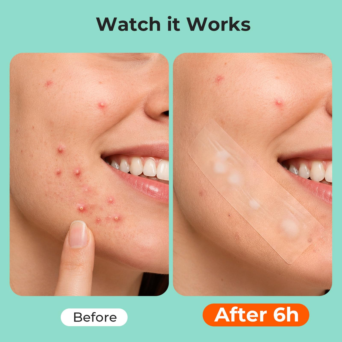 TKTK 443 Count Pimple Patches for Face, Hydrocolloid Acne Patch Bulk, Acne Stickers for Covering Cheeks, Forehead, Chin Blemishes Zit Breakouts for All Skin Types (Dots, Strip, Contoured 5 Sizes)
